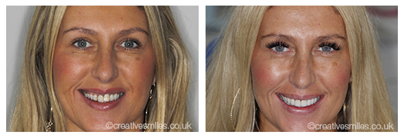 Tooth Whitening Belfast Teeth Whitening Northern Ireland ...